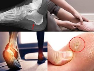 The Most Tried and Tested Natural Remedy for Heel Spur Discomfort