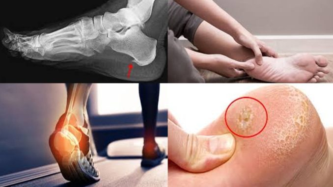 The Most Tried and Tested Natural Remedy for Heel Spur Discomfort