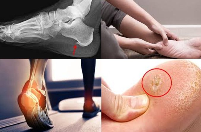 The Most Tried and Tested Natural Remedy for Heel Spur Discomfort